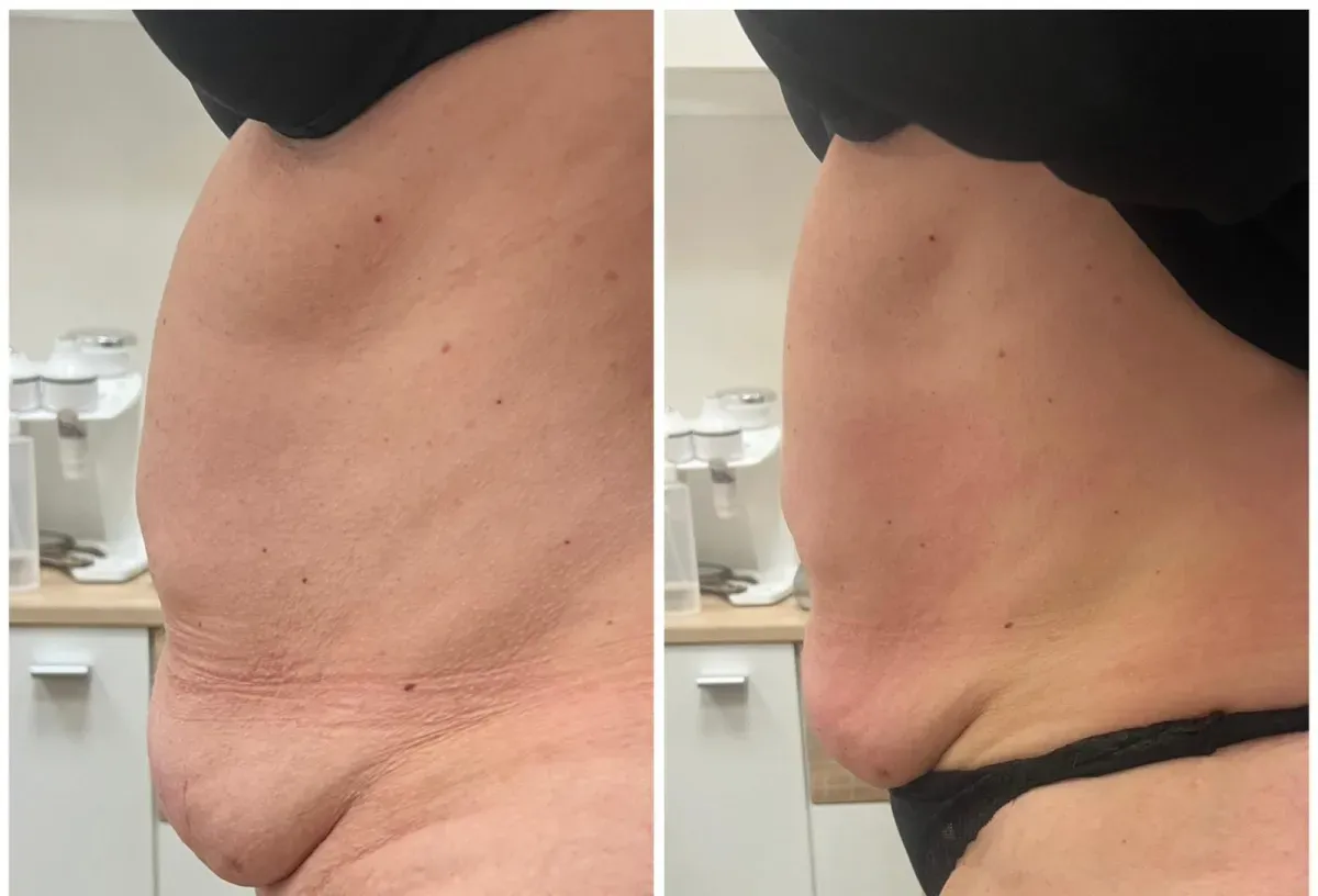 Före och efter fettreducerande behandling hos Vägen till hälsa